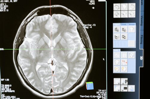 traumatic brain injuries (TBI)