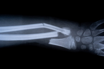 broken arm bone x-ray